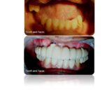 Implant supported full mouth fixed prosthesis