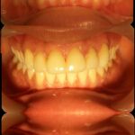 Smile design/ Laminates