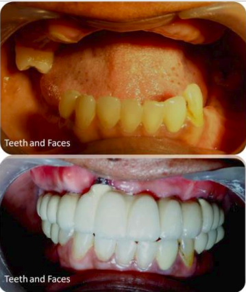 Screenshot of Implant supported full mouth fixed prosthesis
