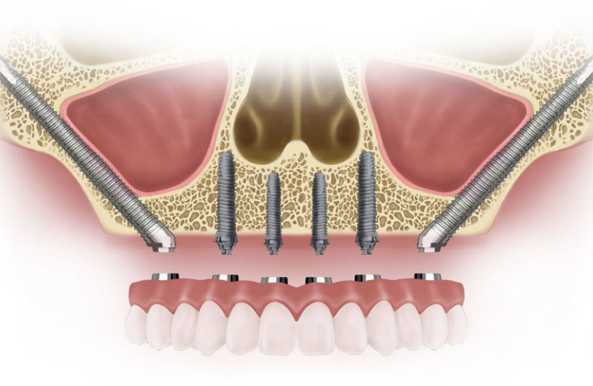 zygomatic implant