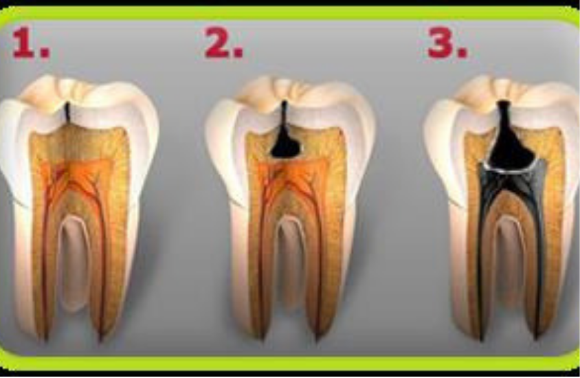 cavity management - tooth filling