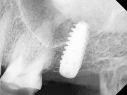 single tooth implant with sinus lift