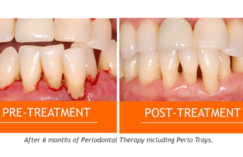 Gum-Disease-and-Treatment2