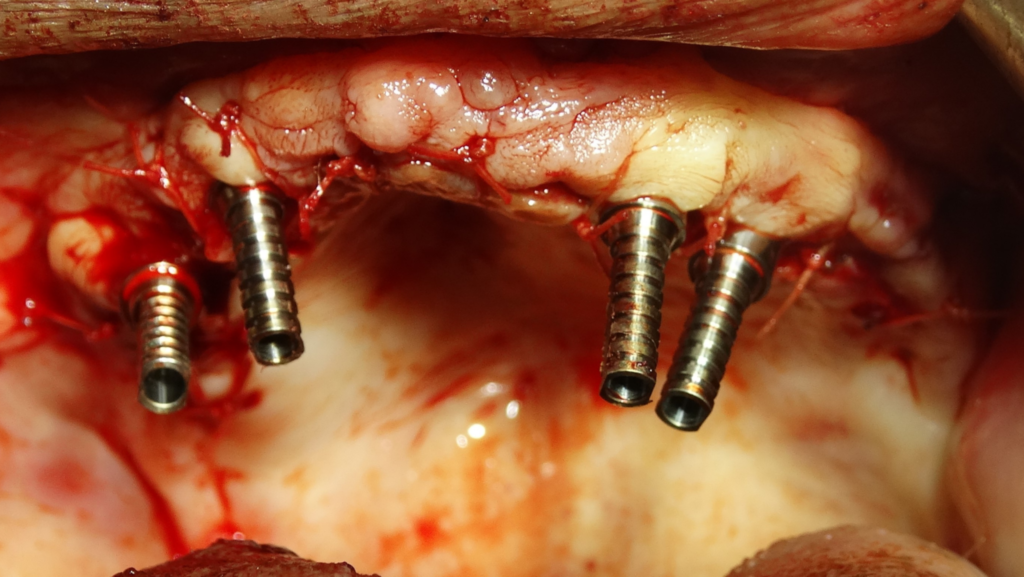 zygomatic implants