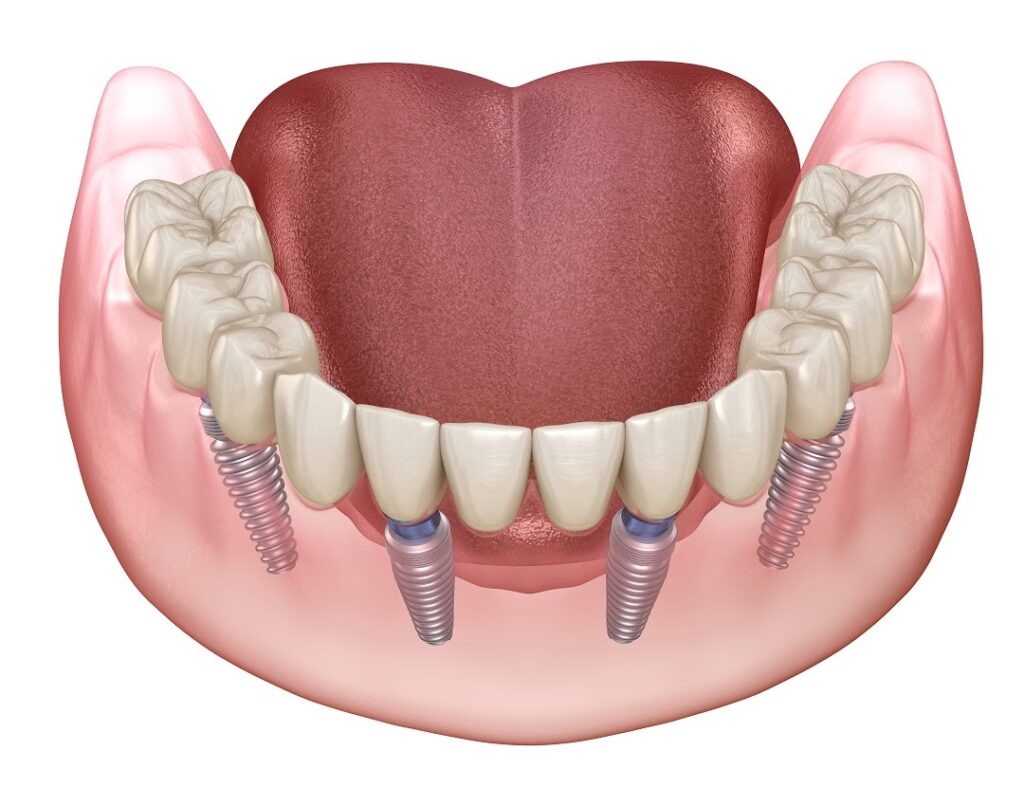 Wisdom Tooth Removal and Oral Surgery